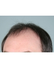 Before Hair Transplant&nbsp;2 Sessions (Areas)